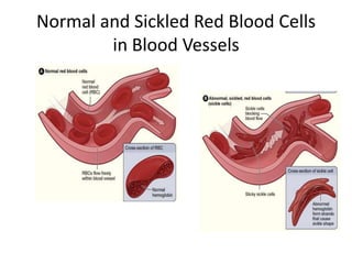 Normal and Sickled Red Blood Cells
in Blood Vessels
 