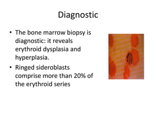 Diagnostic
• The bone marrow biopsy is
diagnostic: it reveals
erythroid dysplasia and
hyperplasia.
• Ringed sideroblasts
comprise more than 20% of
the erythroid series
 