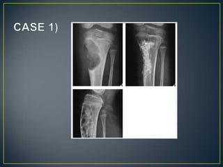 Aproach to bone   tumours