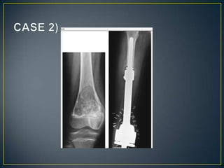 Aproach to bone   tumours