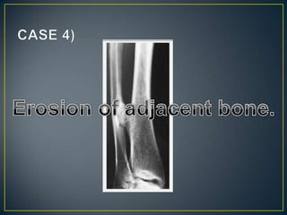 Aproach to bone   tumours