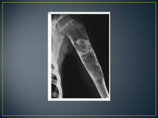 Aproach to bone   tumours