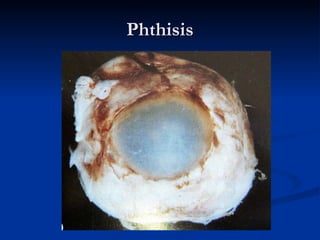 Phthisis 
