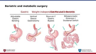 MASSACHUSETTS
GENERAL HOSPITAL
Bariatric and metabolic surgery
Vertical
Sleeve
Gastrectomy
Roux-en-Y
Gastric
Bypass
Gastric
Adjustable
Gastric
Banding
Biliopancreatic
Diversion /
Duodenal Switch
Gastric and Intestinal
Weight-independent Metabolic Benefits
MASSACHUSETTS
GENERAL HOSPITAL
 
