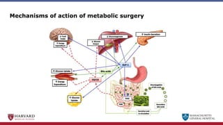 MASSACHUSETTS
GENERAL HOSPITAL
Mechanisms of action of metabolic surgery
 