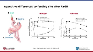 MASSACHUSETTS
GENERAL HOSPITAL
Appetitive differences by feeding site after RYGB
Gero et al., Diab Care 2018; 41:1295-1298
Oral
Gastric
Duodenal
Hunger Fullness
 