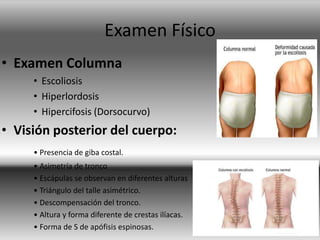Examen Físico
• Examen Columna
• Escoliosis
• Hiperlordosis
• Hipercifosis (Dorsocurvo)
• Visión posterior del cuerpo:
• Presencia de giba costal.
• Asimetría de tronco
• Escápulas se observan en diferentes alturas
• Triángulo del talle asimétrico.
• Descompensación del tronco.
• Altura y forma diferente de crestas ilíacas.
• Forma de S de apófisis espinosas.
 