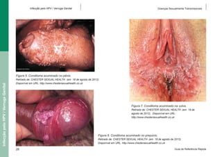 Infecção pelo HPV / Verruga Genital

Doenças Sexualmente Transmissíveis

Infecção pelo HPV / Verruga Genital

Figura 5. Condiloma acuminado no pênis.
Retirado de: CHESTER SEXUAL HEALTH (em 18 de agosto de 2012).
Disponível em URL: http://www.chestersexualhealth.co.uk

Figura 7. Condiloma acuminado na vulva.
Retirado de: CHESTER SEXUAL HEALTH (em 18 de
agosto de 2012). Disponível em URL:
http://www.chestersexualhealth.co.uk

Figura 6. Condiloma acuminado no prepúcio.
Retirado de: CHESTER SEXUAL HEALTH (em 18 de agosto de 2012).
Disponível em URL: http://www.chestersexualhealth.co.uk

28

Guia de Referência Rápida

 