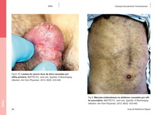 Sífilis

Doenças Sexualmente Transmissíveis

Fig 8- 02: Lesões de cancro duro de 4mm causadas por
sífilis primária. MATTEI P.L. and cols. Syphilis: A Reemerging
Infection. Am Fam Physician. 2012; 86(5): 433-440.

Sífilis

Fig 9: Máculas eritematosas no abdômen causadas por sífilis secundária. MATTEI P.L. and cols. Syphilis: A Reemerging
Infection. Am Fam Physician. 2012; 86(5): 433-440.
34

Guia de Referência Rápida

 