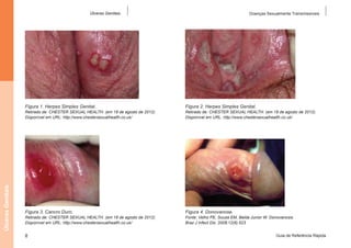 Úlceras Genitais

Doenças Sexualmente Transmissíveis

Figura 1. Herpes Simples Genital.

Figura 2. Herpes Simples Genital.

Figura 3. Cancro Duro.

Figura 4. Donovanose.

Úlceras Genitais

Retirado de: CHESTER SEXUAL HEALTH. (em 18 de agosto de 2012).
Disponível em URL: http://www.chestersexualhealth.co.uk/

Retirado de: CHESTER SEXUAL HEALTH. (em 18 de agosto de 2012).
Disponível em URL: http://www.chestersexualhealth.co.uk/

8

Retirado de: CHESTER SEXUAL HEALTH. (em 18 de agosto de 2012).
Disponível em URL: http://www.chestersexualhealth.co.uk/

Fonte: Velho PE, Souza EM, Belda Junior W. Donovanosis.
Braz J Infect Dis. 2008;12(6):523
Guia de Referência Rápida

 