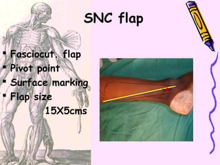 Sural Neurocutaneous Flap by Dr Sumita Shankar, Amaze MedSpa | PPT