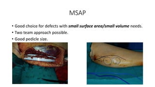 relevance of RAFF in present day head and neck reconstruction.pptx