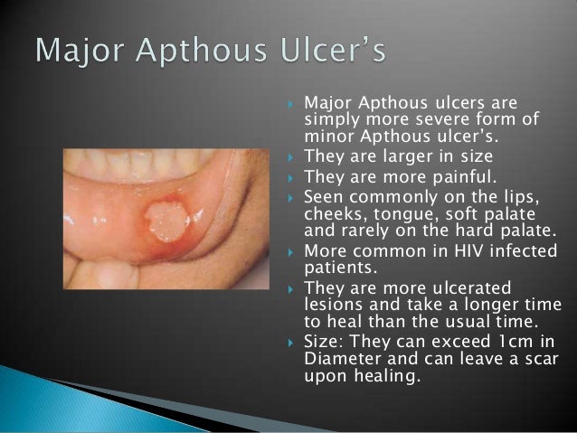 Management And Treatment Of Recurrent Apthous Ulcers