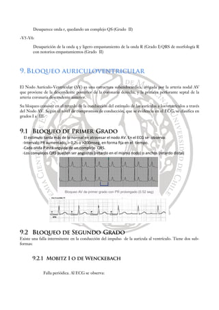 Desaparece onda r, quedando un complejo QS (Grado II)
-V5-V6:
Desaparición de la onda q y ligero empastamiento de la onda R (Grado I) QRS de morfología R
con notorios empastamientos (Grado II)
9.Bloqueo auriculoventricular
El Nodo Aurículo-Ventricular (AV) es una estructura subendocárdica, irrigada por la arteria nodal AV
que proviene de la descendente posterior de la coronaria derecha, y la primera perforante septal de la
arteria coronaria descendente anterior.
Su bloqueo consiste en el retardo de la conducción del estímulo de las aurículas a los ventrículos a través
del Nodo AV. Según el nivel de compromiso de conducción, que se evidencia en el ECG, se clasifica en
grados I a III.
9.1 Bloqueo de Primer Grado
El estímulo tarda más de lo normal en atravesar el nodo AV. En el ECG se observa:
-Intervalo PR aumentado, ˃ 0,2s o ˃200mseg, en forma ﬁja en el tiempo.
-Cada onda P está seguida de un complejo QRS.
-Los complejos QRS pueden ser angostos (retardo en el mismo nodo) o anchos (retardo distal)
9.2 Bloqueo de Segundo Grado
Existe una falla intermitente en la conducción del impulso de la aurícula al ventrículo. Tiene dos sub-
formas:
9.2.1 Mobitz I o de Wenckebach
Falla periódica. Al ECG se observa:
 