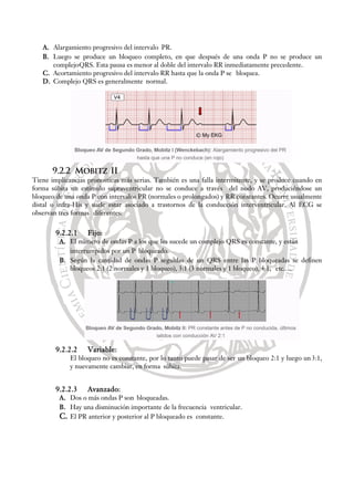 A. Alargamiento progresivo del intervalo PR.
B. Luego se produce un bloqueo completo, en que después de una onda P no se produce un
complejoQRS. Esta pausa es menor al doble del intervalo RR inmediatamente precedente.
C. Acortamiento progresivo del intervalo RR hasta que la onda P se bloquea.
D. Complejo QRS es generalmente normal.
9.2.2 Mobitz II
Tiene implicancias pronosticas más serias. También es una falla intermitente, y se produce cuando en
forma súbita un estímulo supraventricular no se conduce a través del nodo AV, produciéndose un
bloqueo de una onda P con intervalos PR (normales o prolongados) y RR constantes. Ocurre usualmente
distal o infra-His y suele estar asociado a trastornos de la conducción interventricular. Al ECG se
observan tres formas diferentes:
9.2.2.1 Fijo:
A. El número de ondas P a los que les sucede un complejo QRS es constante, y están
interrumpidos por un P bloqueado.
B. Según la cantidad de ondas P seguidas de un QRS entre las P bloqueadas se definen
bloqueos 2:1 (2 normales y 1 bloqueo), 3:1 (3 normales y 1 bloqueo), 4:1, etc.…
9.2.2.2 Variable:
El bloqueo no es constante, por lo tanto puede pasar de ser un bloqueo 2:1 y luego un 3:1,
y nuevamente cambiar, en forma súbita.
9.2.2.3 Avanzado:
A. Dos o más ondas P son bloqueadas.
B. Hay una disminución importante de la frecuencia ventricular.
C. El PR anterior y posterior al P bloqueado es constante.
 