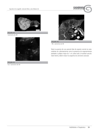 CADERNOSCADERNOSde atención primariade atención primaria
Habilidades e Terapéutica 39
Apuntes de ecografía: vesícula biliar y vías biliares (I)
Tanto la ausencia de una vesicula biliar de aspecto normal sin ante-
cedentes de colecistectomía como la presencia de engrosamientos
parietales o pólipos mayor de 1 cm, sobre todo si muestran vascula-
ridad interna, deben inducir la sospecha de carcinoma vesicular.
FIGURA 44
Carcinoma de VB
FIGURA 46
TAC: carcinoma de VB
FIGURA 45
Eco: Carcinoma de VB
 