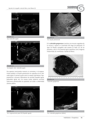 CADERNOSCADERNOSde atención primariade atención primaria
Habilidades e Terapéutica 35
Apuntes de ecografía: vesícula biliar y vías biliares (I)
Dos aspectos mencionados merecen un comentario: ni el engrosa-
miento parietal ni el liquido perivesicular son específicos de la cole-
cistitis aguda. El primero puede verse en estados edematosos, hipo-
proteinemia o procesos inflamatorios de vecindad (hepatitis aguda,
pielonefritis aguda, etc). De manera similar, podemos encontrar
colecciones perivesiculares en pacientes con ascitis o enfermedad
ulcerosa péptica.
En la colecistitis gangrenosa se produce una necrosis coagulativa de
la mucosa y supone un incremento del riesgo de perforación. El
signo de Murphy sonográfico está ausente en hasta 2/3 de los
pacientes y solo un 5% presenta signos específicos como imágenes
intraluminales de membranas o bandas de fibrina.
FIGURA 22
Eco: Colecistitis aguda
FIGURA 23
Eco-doppler color: colecistitis aguda
FIGURA 24
Eco: engrosamiento pared VB (hepatitis aguda)
FIGURA 25
Eco: liquido perivesicular
FIGURA 26
Colecistitis gangrenosa
FIGURA 27
Eco: colecistitis gangrenosa (debris)
 