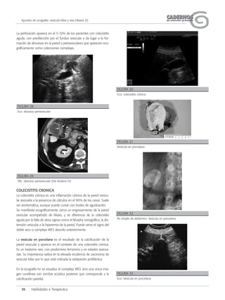 36 Habilidades e Terapéutica
CADERNOSCADERNOSde atención primariade atención primariaApuntes de ecografía: vesícula biliar y vías biliares (I)
La perforación aparece en el 5-10% de los pacientes con colecistitis
aguda, con predilección por el fundus vesicular y da lugar a la for-
mación de abscesos en la pared o perivesiculares que aparecen eco-
gráficamente como colecciones complejas.
COLECISTITIS CRONICA
La colecistitis crónica es una inflamación crónica de la pared vesicu-
lar asociada a la presencia de cálculos en el 90% de los casos. Suele
ser asintomática, aunque puede cursar con brotes de agudización.
Se manifiesta ecográficamente como un engrosamiento de la pared
vesicular acompañado de litiasis, y se diferencia de la colecistitis
aguda por la falta de otros signos como el Murphy sonográfico, la dis-
tensión vesicular o la hiperemia de la pared. Puede verse el signo del
doble arco o complejo WES descrito anteriormente.
La vesícula en porcelana es el resultado de la calcificación de la
pared vesicular y aparece en el contexto de una colecistitis crónica.
Es un trastorno raro, con predominio femenino y en edades avanza-
das. Su importancia radica en la elevada incidencia de carcinoma de
vesicula biliar por lo que está indicada la extirpación profiláctica.
En la ecografía no se visualiza el complejo WES sino una única ima-
gen curvilínea con sombra acústica posterior que corresponde a la
calcificación parietal.
FIGURA 28
Eco: absceso perivesicular
FIGURA 29
TAC: absceso perivesicular (De Rubens D)
FIGURA 30
Eco: colecistitis crónica
FIGURA 31
Vesícula en porcelana
FIGURA 32
Rx simple de abdomen: Vesícula en porcelana
FIGURA 33
Eco: Vesícula en porcelana
 