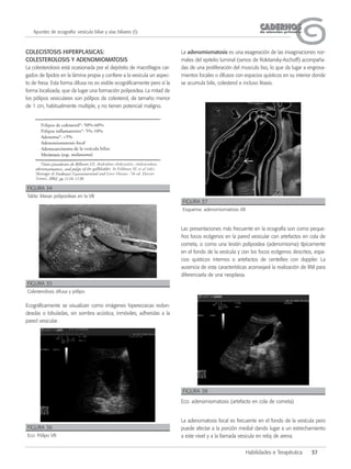 CADERNOSCADERNOSde atención primariade atención primaria
Habilidades e Terapéutica 37
Apuntes de ecografía: vesícula biliar y vías biliares (I)
COLECISTOSIS HIPERPLASICAS:
COLESTEROLOSIS Y ADENOMIOMATOSIS
La colesterolosis está ocasionada por el depósito de macrófagos car-
gados de lípidos en la lámina propia y confiere a la vesicula un aspec-
to de fresa. Esta forma difusa no es visible ecográficamente pero sí la
forma localizada, que da lugar una formación polipoidea. La mitad de
los pólipos vesiculares son pólipos de colesterol, de tamaño menor
de 1 cm, habitualmente multiple, y no tienen potencial maligno.
Ecográficamente se visualizan como imágenes hiperecoicas redon-
deadas o lobuladas, sin sombra acústica, inmóviles, adheridas a la
pared vesicular.
La adenomiomatosis es una exageración de las invaginaciones nor-
males del epitelio luminal (senos de Rokitansky-Aschoff) acompaña-
das de una proliferación del musculo liso, lo que da lugar a engrosa-
mientos focales o difusos con espacios quísticos en su interior donde
se acumula bilis, colesterol e incluso litiasis.
Las presentaciones más frecuente en la ecografía son como peque-
ños focos ecógenos en la pared vesicular con artefactos en cola de
cometa, o como una lesión polipoidea (adenomioma) típicamente
en el fondo de la vesícula y con los focos ecógenos descritos, espa-
cios quísticos internos o artefactos de centelleo con doppler. La
ausencia de esta características aconsejará la realización de RM para
diferenciarla de una neoplasia.
La adenomatosis focal es frecuente en el fondo de la vesícula pero
puede afectar a la porción medial dando lugar a un estrechamiento
a este nivel y a la llamada vesicula en reloj de arena.
FIGURA 34
Tabla: Masas polipoideas en la VB
FIGURA 35
Colesterolosis difusa y pólipo
FIGURA 36
Eco: Pólipo VB
FIGURA 37
Esquema: adenomiomatosis VB
FIGURA 38
Eco: adenomiomatosis (artefacto en cola de cometa)
 