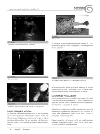 38 Habilidades e Terapéutica
CADERNOSCADERNOSde atención primariade atención primariaApuntes de ecografía: vesícula biliar y vías biliares (I)
TUMORES BENIGNOS: ADENOMA
Los adenomas son neoplasias benignas de la VB que se presentan
como lesiones polipoideas habitualmente solitarias, mucho más
infrecuentes que los pólipos de colesterol, y a los que se atribuye
cierto potencial premaligno (hay una asociación más fuerte entre
colecistitis crónica y cáncer de vesícula que entre adenoma y carci-
noma).
En la ecografía se ven como lesiones polipoides menores de 2 cms,
típicamente ecogénicas cuando son pequeñas y más heterogéneas a
medida que crecen.
La literatura quirúrgica habitual recomienda la exéresis de aquellos
pólipos mayores de 1 cm a partir de los 50 años o cualquier pólipo
que demuestra crecimiento con independencia del tamaño.
CARCINOMA DE VESÍCULA BILIAR
Es una neoplasia infrecuente, con predominio en mujeres (2:1 ratio)
y una edad media de presentación de 72 años. El mayor factor de
riesgo es la colecistitis crónica; también se asocia a la colangitis escle-
rosante primaria y a los quistes de colédoco.
Habitualmente se diagnostica en estadios avanzados,como una masa
que reemplaza completamente la vesícula (40-65%), con menor fre-
cuencia como engrosamiento parietal focal o difuso (20-30%) o
como pólipo intraluminal (15-25%).
El aspecto ecográfico más frecuente es el de una masa heterogénea
que invade el parénquima hepático, a veces con un “cálculo atrapa-
do” y con vascularidad interna prominente.
FIGURA 39
Eco-doppler color: Adenomiomatosis (centelleo)
FIGURA 42
Adenoma VB
FIGURA 40
Eco: adenomioma
FIGURA 43
Eco(power doppler): adenoma VB (De Dogra V, Rubens D)
FIGURA 41
Eco y ERCP: Adenomiomatosis focal (vesícula en reloj de arena)
 