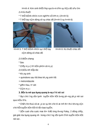 H×nh 4: Kim sinh thiÕt l¾p vµo b¬m tiªm vµ ®Çu dß siªu ©m
2.4 Kü thuËt
* T thÕ bÖnh nh©n n»m nghiªm vÒ bªn tr¸i (h×nh 5)
* T thÕ tay cÇm dông cô vµ chäc dß (h×nh 5 vµ h×nh 6)
H×nh 5: T thÕ bÖnh nh©n vµ t thÕ tay
cÇm dông cô chäc dß
H×nh 6: Kü thuËt chäc dß
2.5 BiÕn chøng
* §au
* Ch¶y m¸u ( ®¹i tiÖn ph©n cã m¸u)
2.6 §iÒu trÞ tiÕp tôc
* Kh¸ng sinh
+ quinolone sau ®ã theo kh¸ng sinh ®å
+ metronidazole
* gi¶m ®au, h¹ sèt
* CÇm m¸u :
3. DÉn lu mñ qua bµng quang b»ng c¾t néi soi
* Bµi c¾t t¨ng s¶n lµnh tuyÕn tiÒn liÖt b»ng ph¬ng ph¸p néi soi
qua niÖu ®¹o.
* ChØ c¾t thuú cã æ ¸p xe vµ khi c¾t tíi æ mñ th× th«i kh«ng cÇn
c¾t hÕt tuyÕn tiÒn liÖt tíi tËn bao tuyÕn.
* §Õn cuèi cña cuéc mæ th× ®Æt èng th«ng Foley, 2 dßng ch¶y,
giá giät röa bµng quang nh trong c¾t t¨ng s¶n lµnh tÝnh tuyÕn tiÒn liÖt
néi soi .
4
 