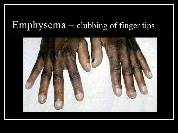 Aqa B1a 11[1].3 Smoking Rg