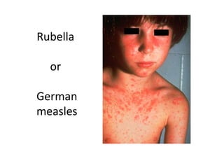 Rubella

  or

German
measles
 