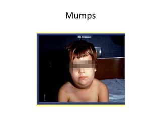 Mumps
 