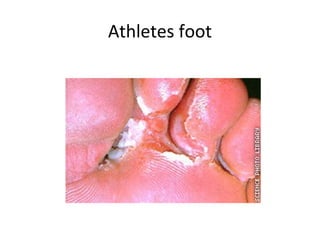 Athletes foot
 