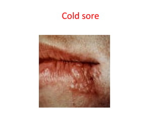 Cold sore
 