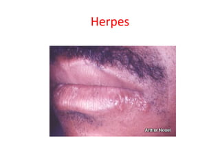 Herpes
 