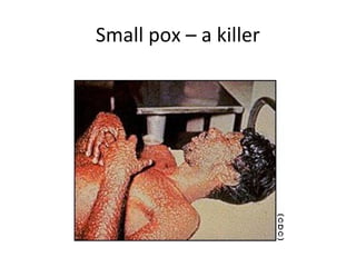 Small pox – a killer
 