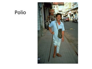 Polio
 