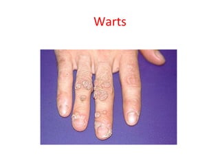Warts
 