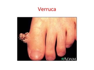 Verruca
 