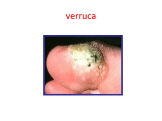 verruca
 