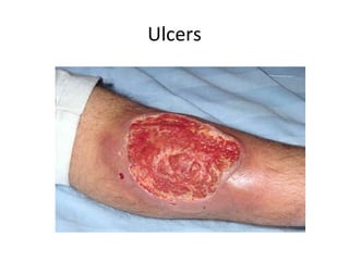 Ulcers
 