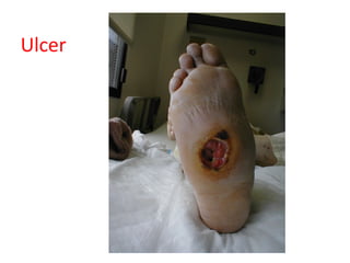 Ulcer
 
