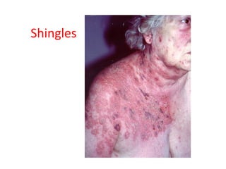 Shingles
 