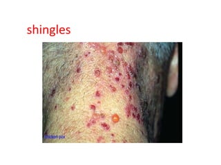 shingles
 