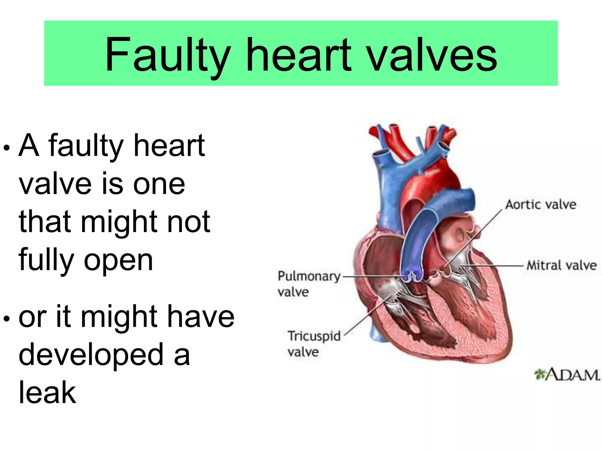 Faulty heart valves
• A faulty heart
valve is one
that might not
fully open
• or it might have
developed a
leak
 