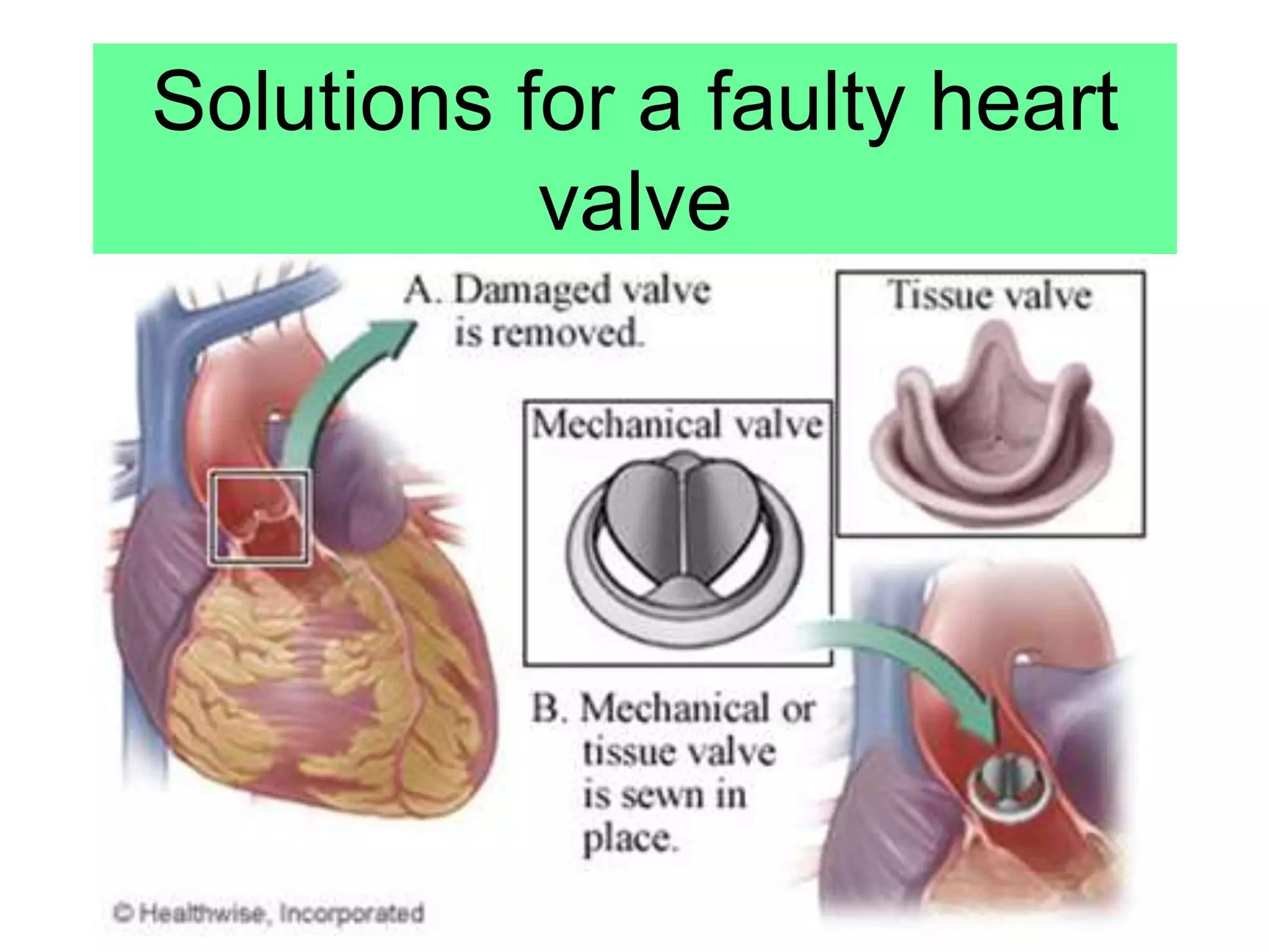 Solutions for a faulty heart
valve
 