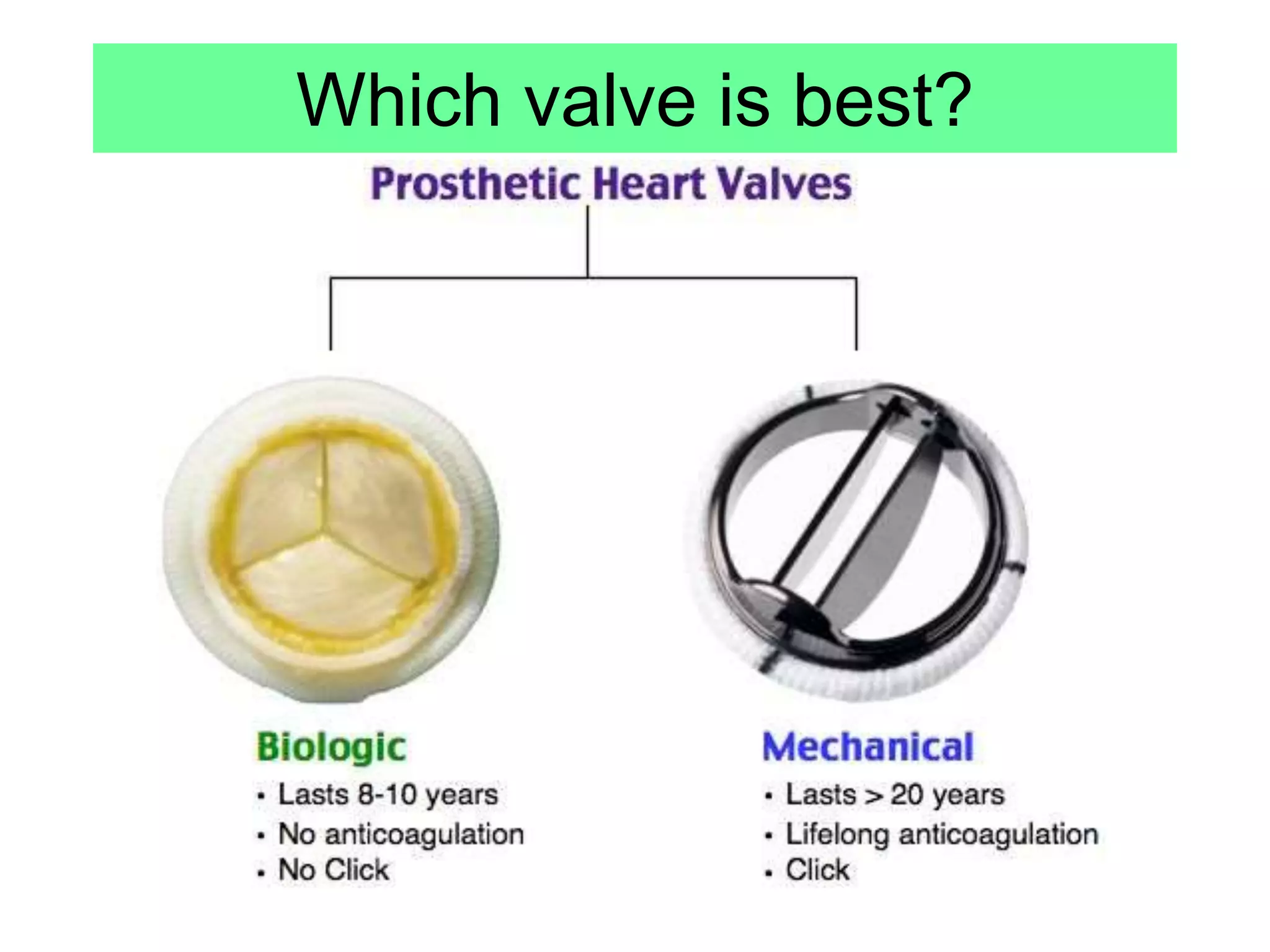 Which valve is best?
 