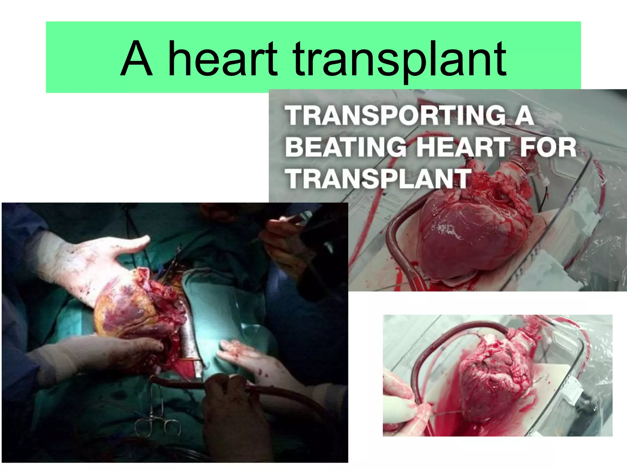 A heart transplant
 