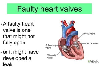 Faulty heart valves
• A faulty heart
valve is one
that might not
fully open
• or it might have
developed a
leak
 