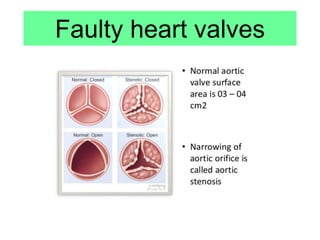 Faulty heart valves
 