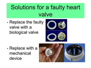 Solutions for a faulty heart
valve
• Replace the faulty
valve with a
biological valve
• Replace with a
mechanical
device
 