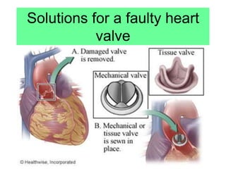 Solutions for a faulty heart
valve
 