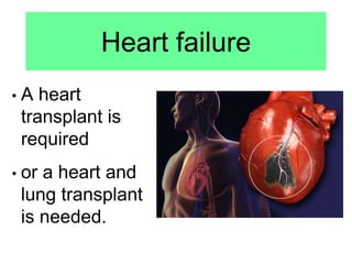 Heart failure
• A heart
transplant is
required
• or a heart and
lung transplant
is needed.
 