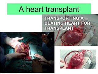 A heart transplant
 